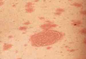 ジベル薔薇色粃糠疹の拡大写真です