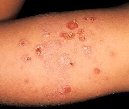 伝染性膿痂疹の写真です
