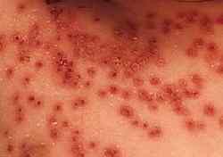 カポジ水痘様発疹症の発疹の拡大です