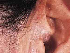 耳の脂漏性皮膚炎です
