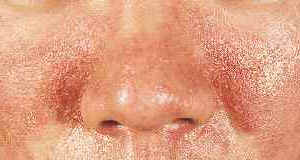 顔の脂漏性皮膚炎です